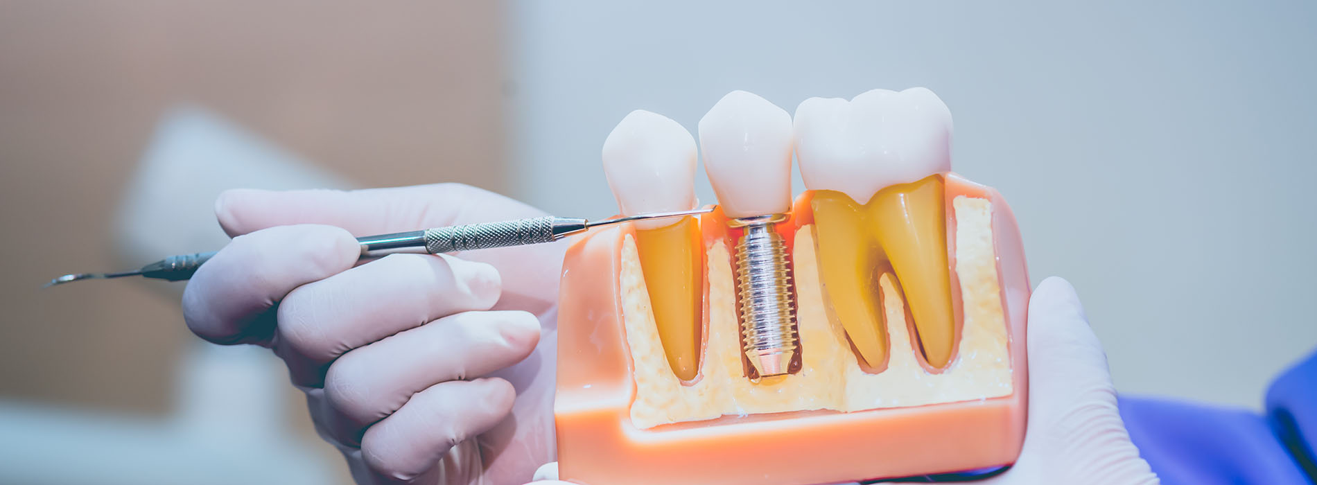 A person holding a dental implant with a screwdriver, set against a blurred background.